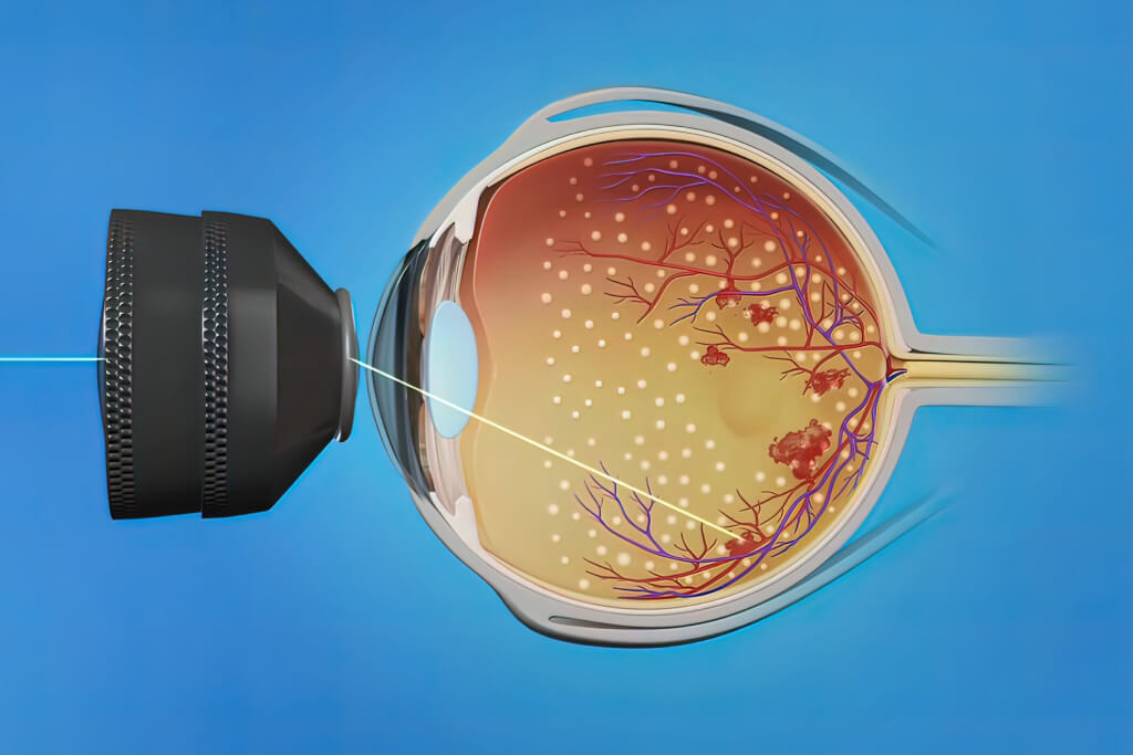 progression of diabetic retinopathy